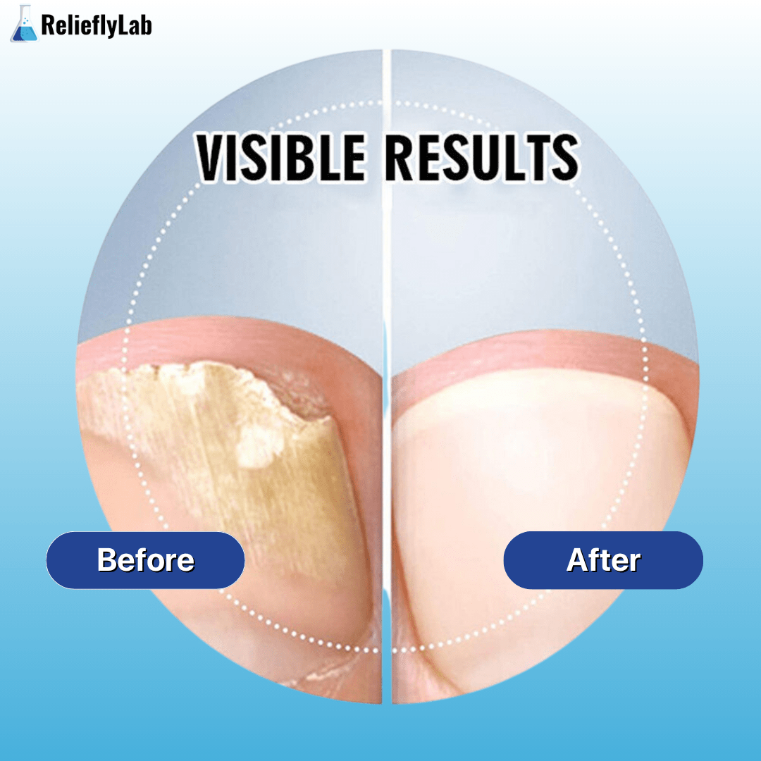 RelieflyLab® | Nail Fungus Pen